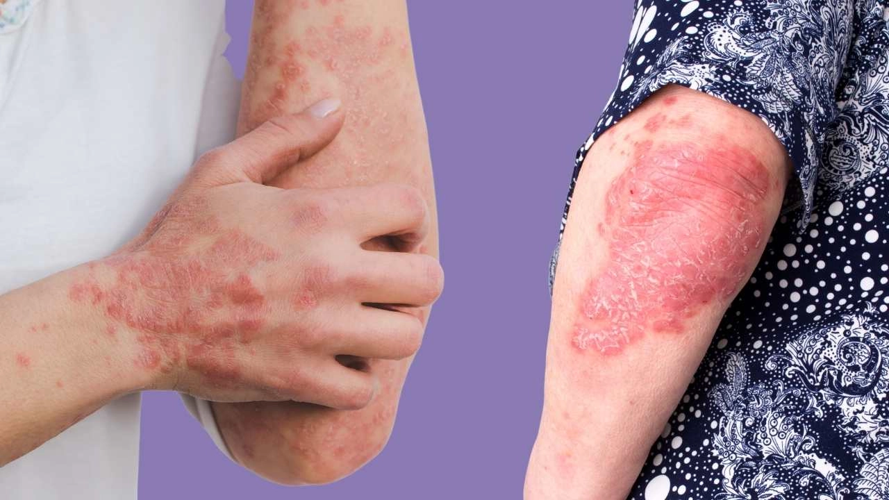 Psoriasis