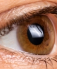 Keratoconus