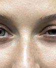 Myasthenia