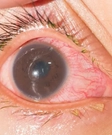 Uveitis