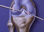 ACL Surgery