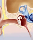 Acoustic neuroma