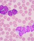 Acute myeloid leukemia