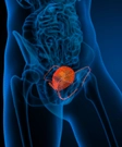 Bladder Cancer