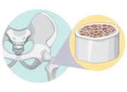 Bone Marrow Transplant