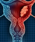 Cervical Cancer