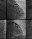 Coronary Angiography