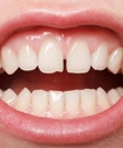 Diastema Closure