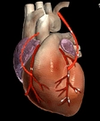 Heart Bypass surgery