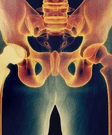 Hip Replacement