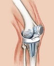 Knee Replacement