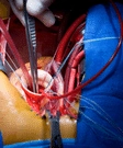 Valve Replacement Surgery